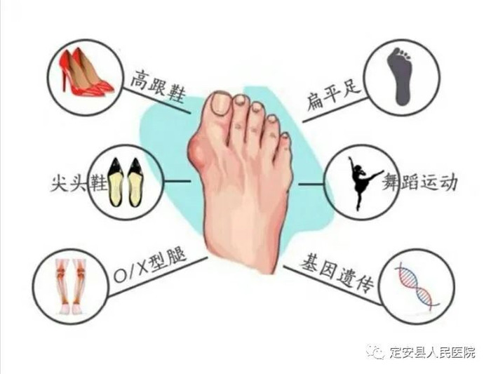 【新技術(shù)】我院外二科圓滿完成首例足踇外翻矯形手術(shù)，讓患者“足”夠漂亮